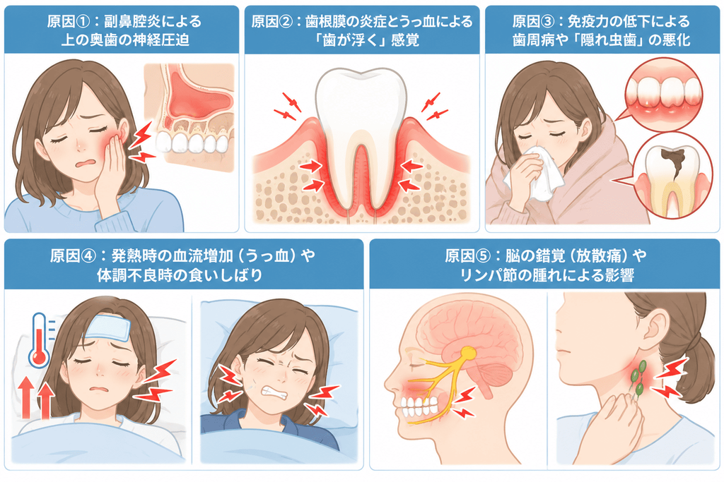 ▼見出しの目次
原因①:副鼻腔炎による上の奥歯の神経圧迫
原因②:歯根膜の炎症とうっ血による「歯が浮く」感覚
原因③:免疫力の低下による歯周病や「隠れ虫歯」の悪化
原因④:発熱時の血流増加(うっ血)や体調不良時の食いしばり
原因⑤:脳の錯覚(放散痛)やリンパ節の腫れによる影響