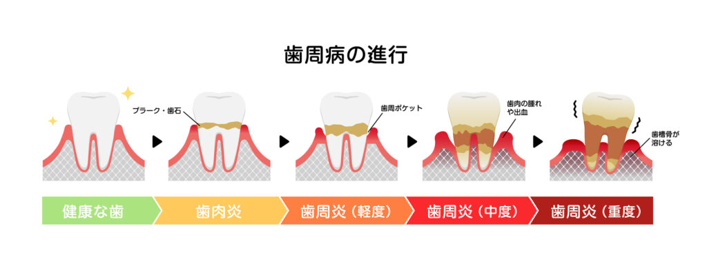 歯周病の進行度を段階的に表した図。進行度別に主な症状が描かれている。