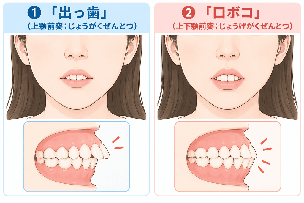 出っ歯と口ボコを図示したもの