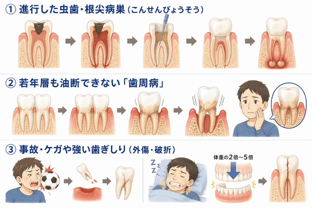 なぜ歯を失う?20代〜50代に多い「歯がない」主な原因3つを図示したもの
