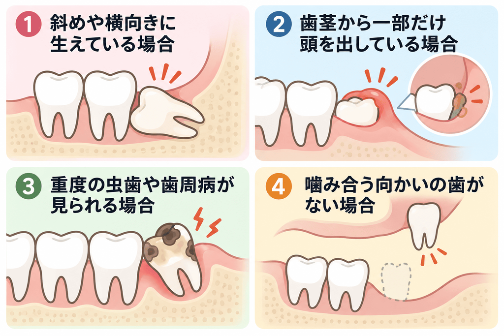 【抜歯が推奨される主な4つのケース】の目次
