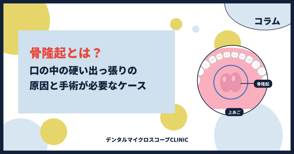 骨隆起の原因と手術が必要なケースを解説するコラムのアイキャッチ。上あごの真ん中にできた骨のふくらみ（骨隆起）を示した口の中のイラスト